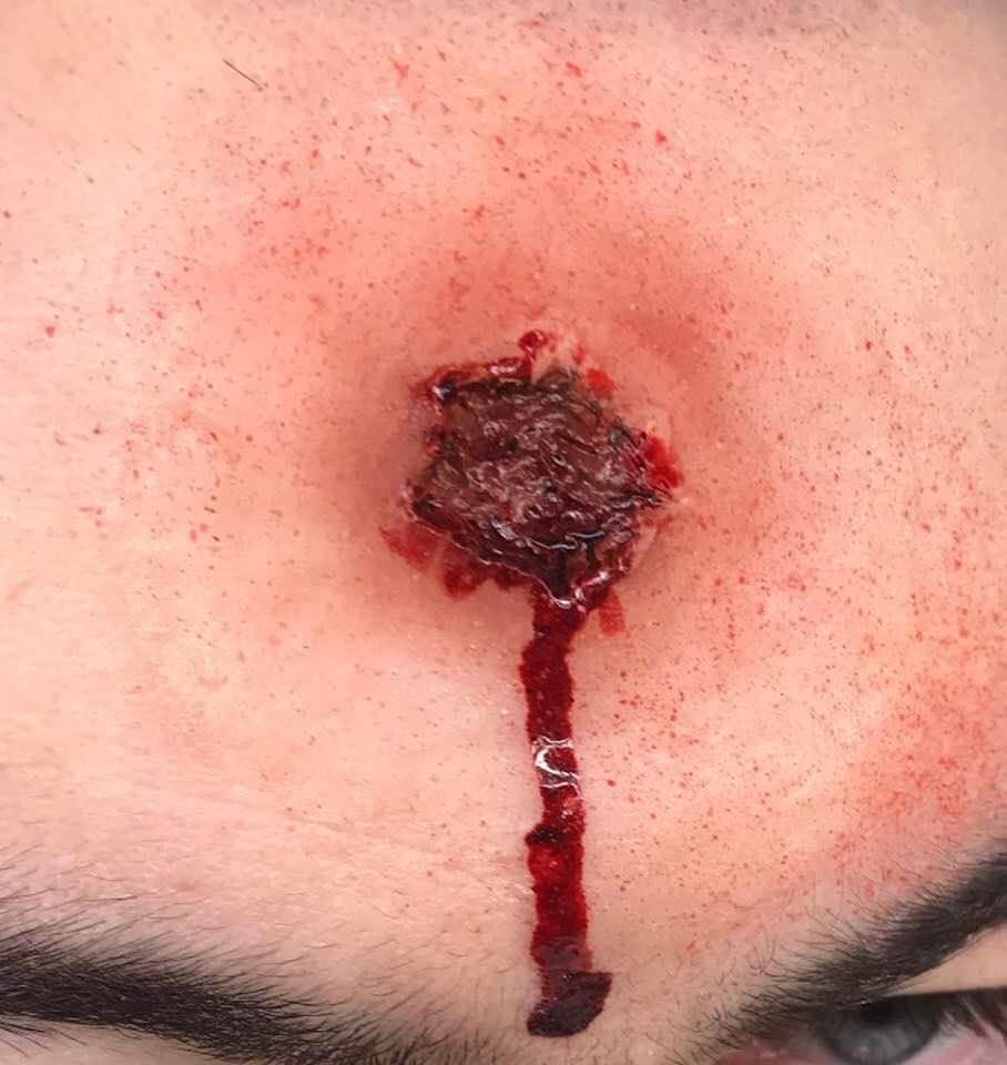 Bullet Wound