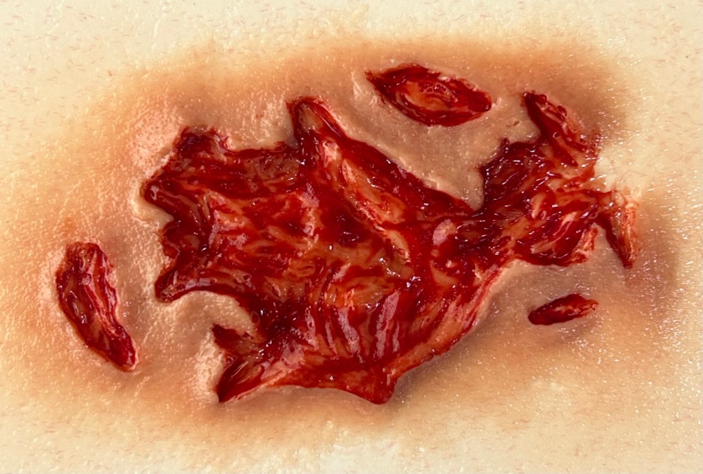 Pre-painted Wound Appliance